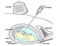 Amniocentesi